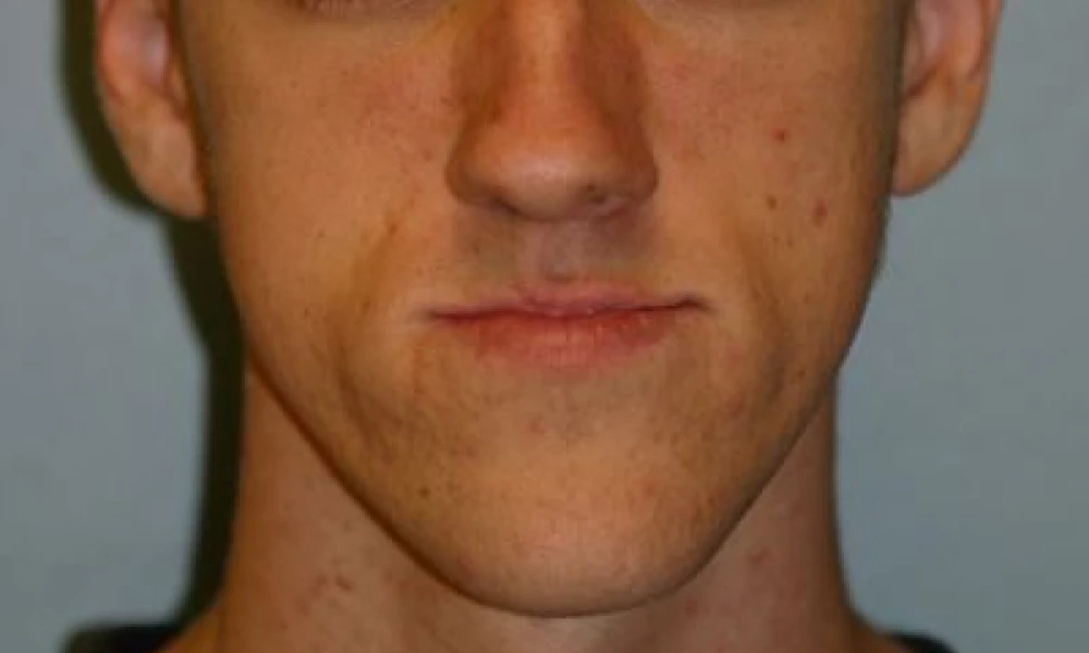 Clinical photo from Joe's corrective jaw surgery case